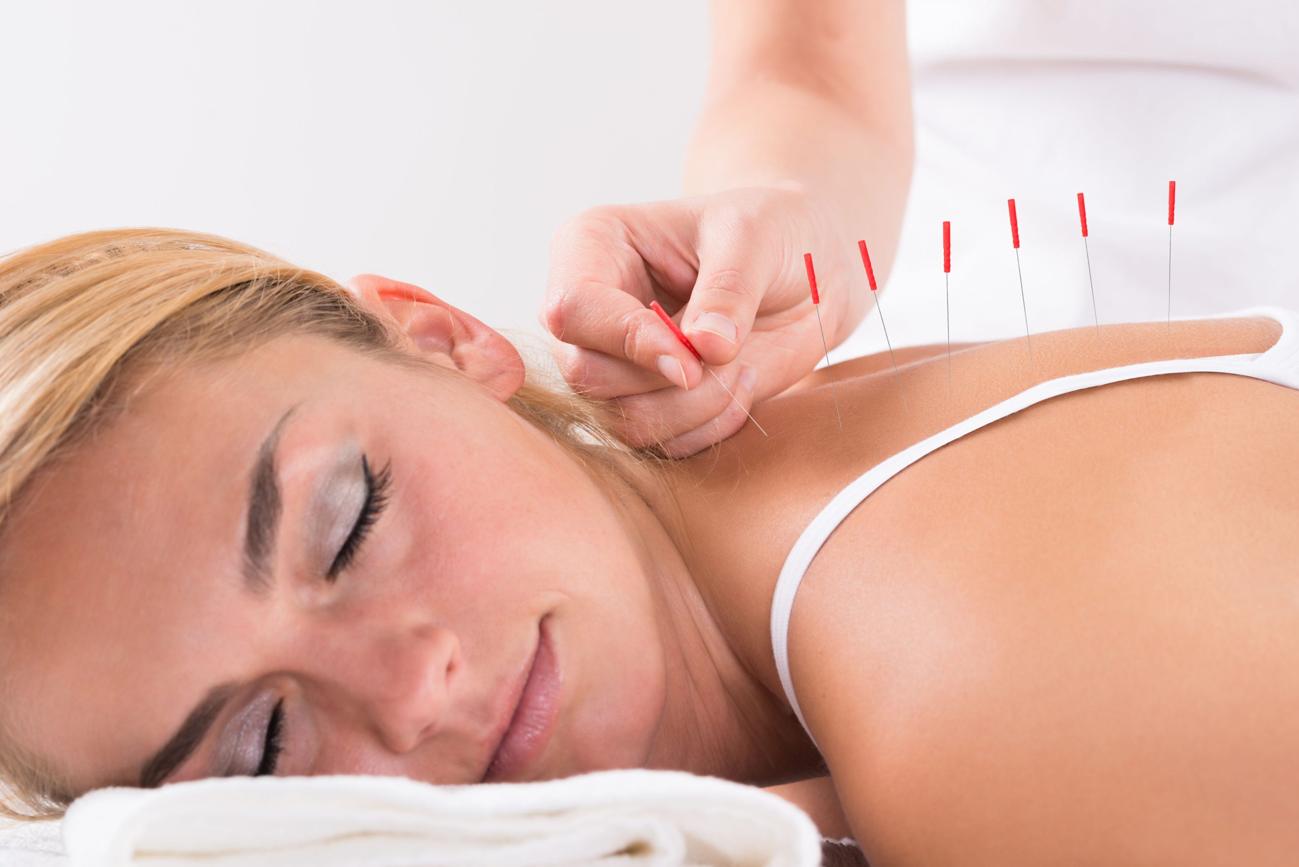 48039006 - closeup of hand performing acupuncture therapy on customer's back at salon